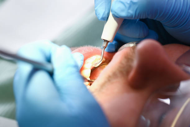 Best Emergency Gum Treatment in Alexandria, LA